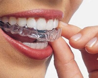 Agrawal-Dental-Clinic-Expert-in-Clear-Aligners-and-Invisalign-Treatment