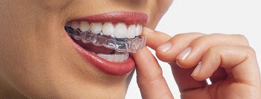 Best Invisible Braces in Thane | Invisalign Dentist